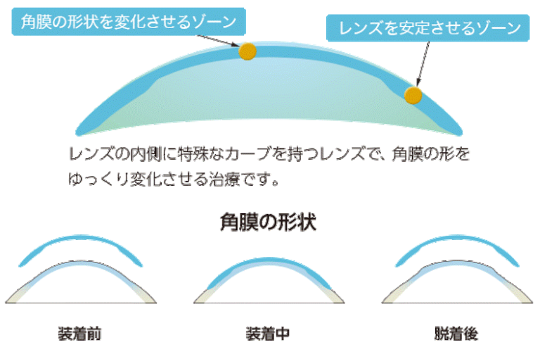 特殊なレンズデザインが角膜の形状を矯正