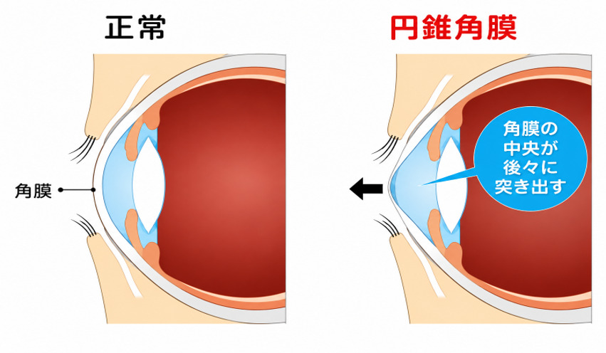 円錐角膜