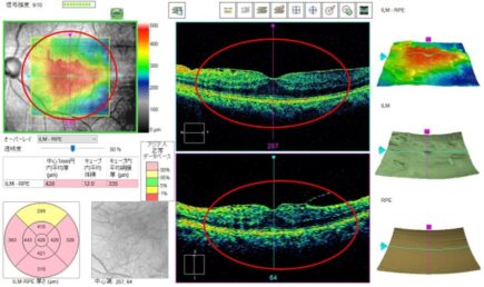 黄斑前膜（黄斑上膜）とは