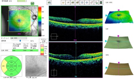 黄斑前膜（黄斑上膜）とは