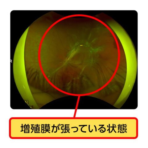 増殖糖尿病網膜眼底